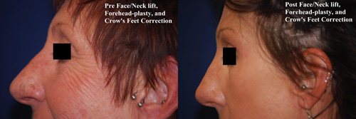 face-neck-lift-plastic-surgery-2